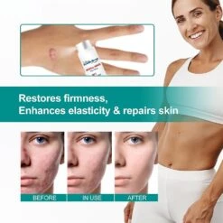 New Scar Remove Advanced Spray For All Types Of Scars, Especially Acne Scars, Surgical Scars And Stretch Marks