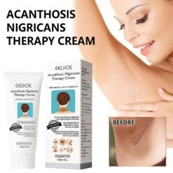 3pcs Acanthosis Cream Nigrifix Cream For Acanthosis Nigricans Black Spot