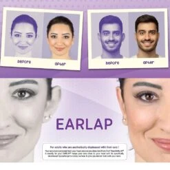 Earlap Cauliflower- Protruding Ear Concealer Corrector (earlap) -Cosmetics Promotion Store 1233641293 max