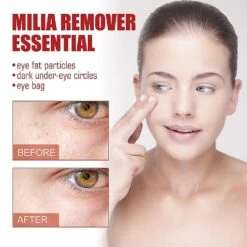 Milia Remover Serum Milia Spot Treatment Helps Dissolve And Reduce Oil Bump Uk -Cosmetics Promotion Store 1284111040 max
