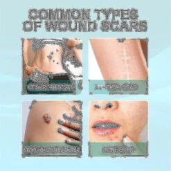 1-3pcs Scar Removal Spray Medical Grade Treatment Acne Scars,surgical Scars, And Stretch Marks Natural 1PC -Cosmetics Promotion Store 1293168559 max