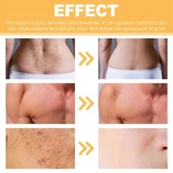 1/2/3pcs Scar Removal Spray Medical Grade Smoothing For Pregnancy Surgical Scars Burn 1pc