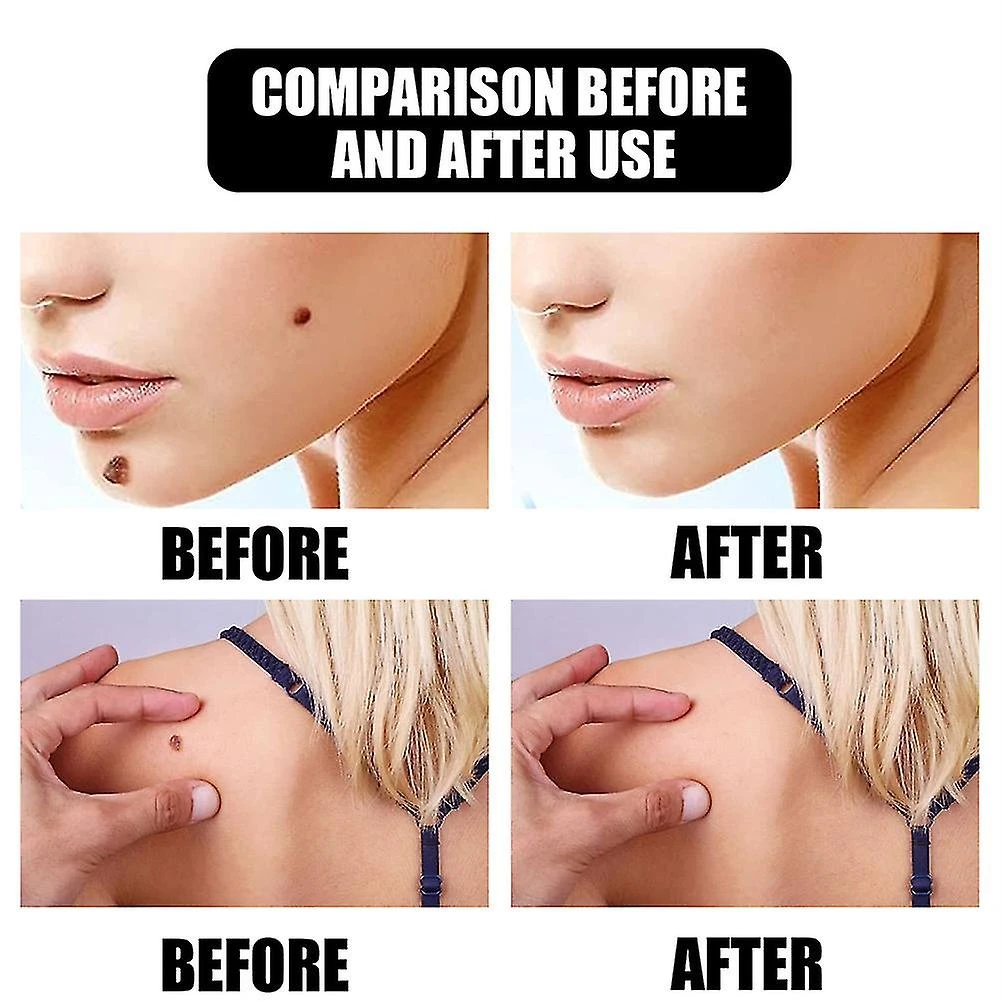 Fast Skin Tag Remover Serum Natural Treatment Moles Warts & Tags 5 Fast Skin Tag Remover Serum Natural Treatment Moles Warts & Tags - Image 5