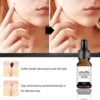 Fast Skin Tag Remover Serum Natural Treatment Moles Warts & Tags