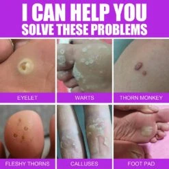 2pcs Wart Removing Liquid Skin Removing Thorn Flat Skin Hand And Foot Cocoon Corns Removing Wart Liquid