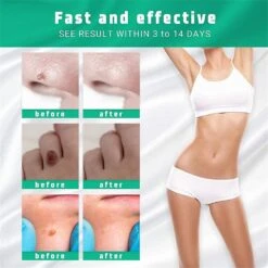 1/2/3Pcs Skin Tag Remover Wart Treatment Painless Mole Skin Dark Spot Wart Removal Serum Freckle Face Tags Remove Cream Essential Oil 2pcs