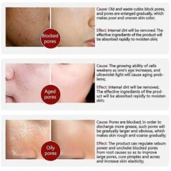 Blackhead Remover Cream Facial Nose Mask Plant Pore Strips Acne Peel Off Pore Treatment Essence Set -Cosmetics Promotion Store 1381700914 max