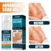 Scar Cream Gel Keloid Removal Repair Scar Cream Removal Scar Marks For Face Or Body