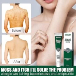 Psoriasis Cream Skin Removal Cream Pityriasis Versicolor Sweat Spots Skin Itching Cream -Cosmetics Promotion Store 1394629095 max