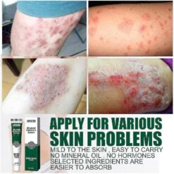 Psoriasis Cream Skin Removal Cream Pityriasis Versicolor Sweat Spots Skin Itching Cream -Cosmetics Promotion Store 1394629105 max