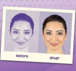 Earlap Cauliflower- Protruding Ear Concealer Corrector (earlap)