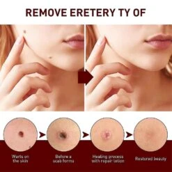 3pcs Tags And Moles Remover Wipeoff Tags& Moles Remove Quick &safe Remove