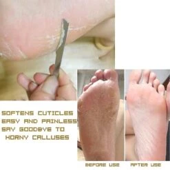 Exfoliating Knife Pedicure Tool - Professional Nail Knife Tool And Foot File Pedicure Set