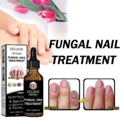 50ml Nail Fungus Treatment Oil For Whitening Hand And Foot Nails -Cosmetics Promotion Store 1543546585 max