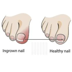 10pcs Ingrown Toenail Pedicure Tool Straightening Clip Curved Brace Toenails Thi -Cosmetics Promotion Store 197019352 max