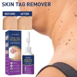 Mole Tag Wart Remover Antibacterial Solution Remove Fleshy Particle Cream 7 Mole Tag Wart Remover Antibacterial Solution Remove Fleshy Particle Cream -Cosmetics Promotion Store 304805426 max