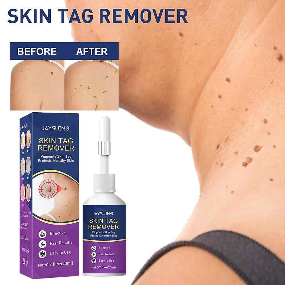 Mole Tag Wart Remover Antibacterial Solution Remove Fleshy Particle Cream 4 Mole Tag Wart Remover Antibacterial Solution Remove Fleshy Particle Cream - Image 4