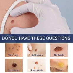 Mole Tag Wart Remover Antibacterial Solution Remove Fleshy Particle Cream