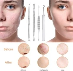 Dww-stainless Steel Blackhead Remover - Blackhead Acne Prone Blackhead Remover For Skin -Cosmetics Promotion Store 610138552 max