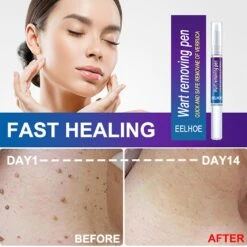 Removing Against Moles Remover Anti Verruca Remedy Liquid Pen Treatment Warts Liquid From Skin Tags