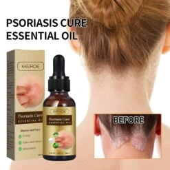 Itchy Skin Psoriasis Oil Portable Not Irritating Instant Refreshment Oil For Pruritus Psoriasis Anti-itching -Cosmetics Promotion Store 848862809 max