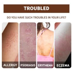 Itchy Skin Psoriasis Oil Portable Not Irritating Instant Refreshment Oil For Pruritus Psoriasis Anti-itching