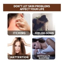 Itchy Skin Psoriasis Oil Portable Not Irritating Instant Refreshment Oil For Pruritus Psoriasis Anti-itching -Cosmetics Promotion Store 848862952 max