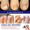 Nail Repair Fluid Toenail And Nail Solution Toenails And Nails Repair Damaged And Discolored Nails 10ML