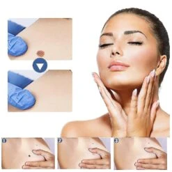 Warts & Moles Treat Patch Fast Healing Dark Moles Remover Painless Skin Nevus Removal Patch 3pcs